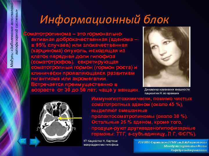 Модуль: «Заболевания гипоталамогипофизарной системы» Информационный блок Соматотропинома – это гормонально активная доброкачественная (аденома –