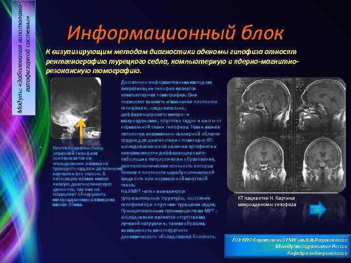 Модуль: «Заболевания гипоталамогипофизарной системы» Информационный блок К визуаизирующим методам диагностики аденомы гипофиза относят рентгенографию