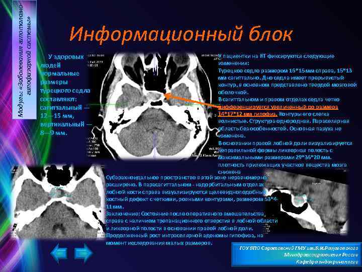 Остеопороз стенки турецкого седла