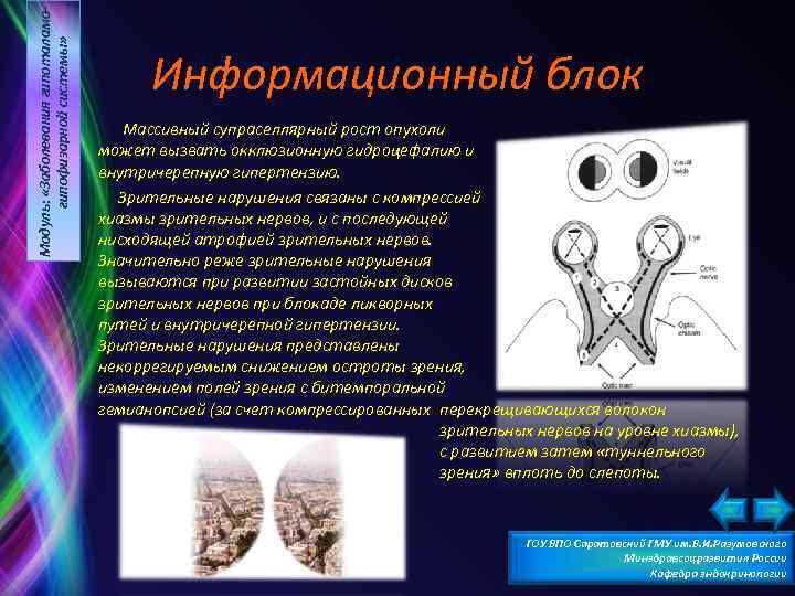 Модуль: «Заболевания гипоталамогипофизарной системы» Информационный блок Массивный супраселлярный рост опухоли может вызвать окклюзионную гидроцефалию