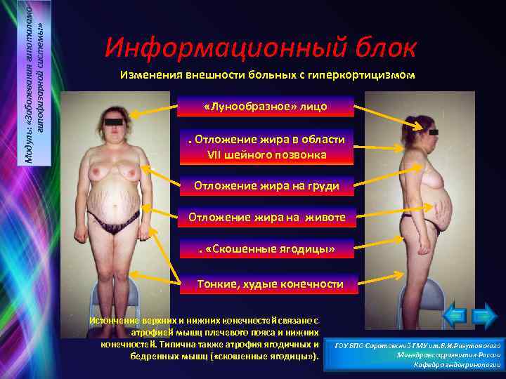 Модуль: «Заболевания гипоталамогипофизарной системы» Информационный блок Изменения внешности больных с гиперкортицизмом «Лунообразное» лицо. Отложение