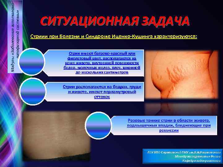 Модуль: «Заболевания гипоталамогипофизарной системы» СИТУАЦИОННАЯ ЗАДАЧА Стриии при Болезни и Синдроме Иценко Кушинга характеризуются: