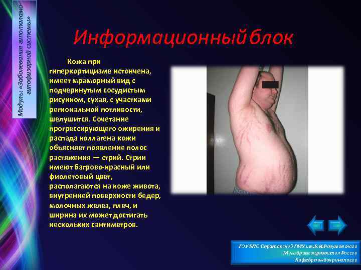 Модуль: «Заболевания гипоталамогипофизарной системы» Информационный блок Кожа при гиперкортицизме истончена, имеет мраморный вид с