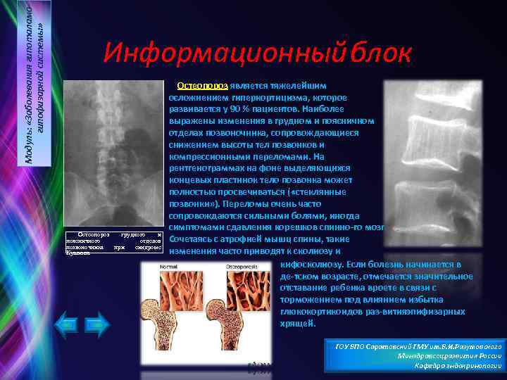 Модуль: «Заболевания гипоталамогипофизарной системы» Информационный блок Остеопороз грудного и поясничного отделов позвоночника при синдроме