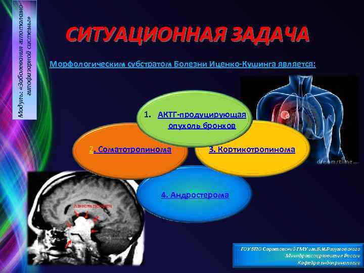 Модуль: «Заболевания гипоталамогипофизарной системы» СИТУАЦИОННАЯ ЗАДАЧА Морфологическим субстратом Болезни Иценко Кушинга является: 1. АКТГ