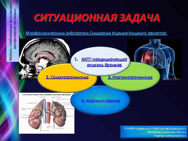Модуль: «Заболевания гипоталамогипофизарной системы» СИТУАЦИОННАЯ ЗАДАЧА Морфологическим субстратом Синдрома Иценко Кушинга является: 1. АКТГ