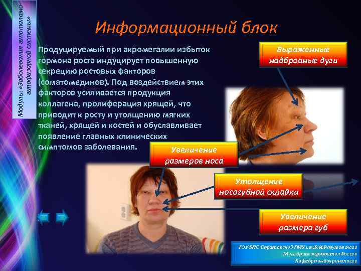 Модуль: «Заболевания гипоталамогипофизарной системы» Информационный блок Продуцируемый при акромегалии избыток гормона роста индуцирует повышенную