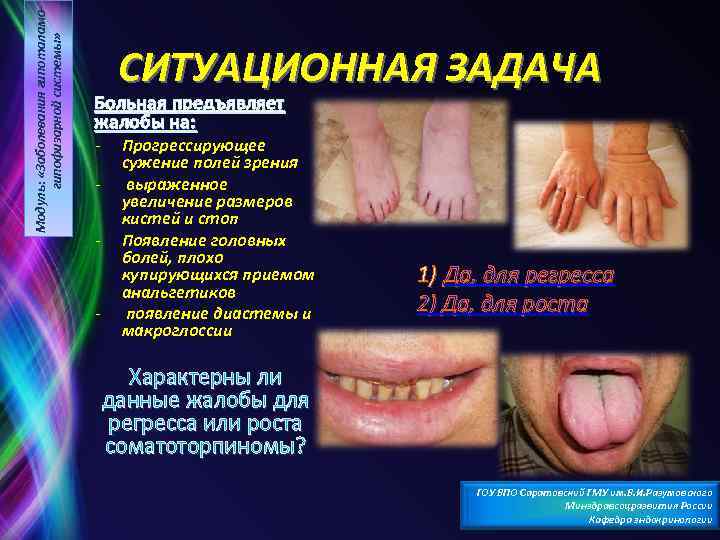 Модуль: «Заболевания гипоталамогипофизарной системы» СИТУАЦИОННАЯ ЗАДАЧА Больная предъявляет жалобы на: - - Прогрессирующее сужение