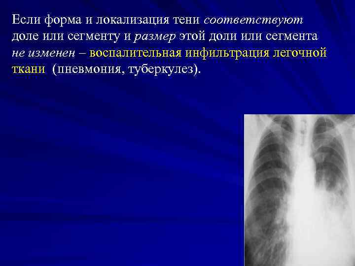 Если форма и локализация тени соответствуют доле или сегменту и размер этой доли или