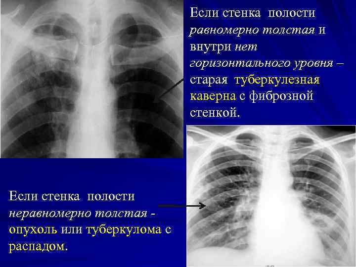       Если стенка полости     равномерно