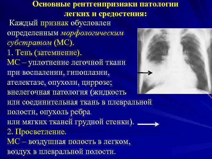   Основные рентгенпризнаки патологии   легких и средостения:  Каждый признак обусловлен