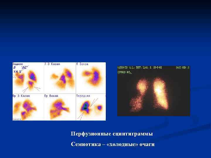 Перфузионные сцинтиграммы Семиотика – «холодные» очаги 