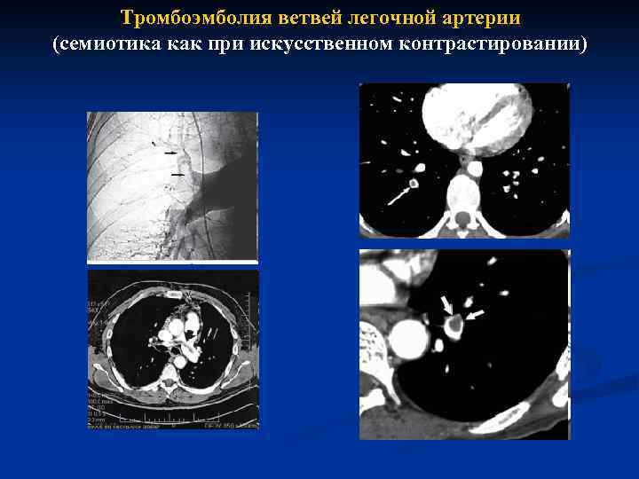 Тромбоэмболия ветвей легочной артерии (семиотика как при искусственном контрастировании) 