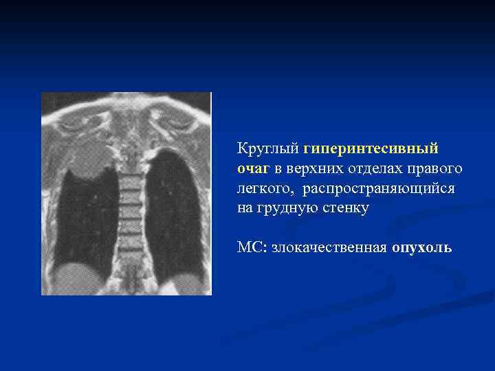 Круглый гиперинтесивный очаг в верхних отделах правого легкого, распространяющийся на грудную стенку МС: злокачественная