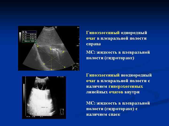 Узи плевральной полости