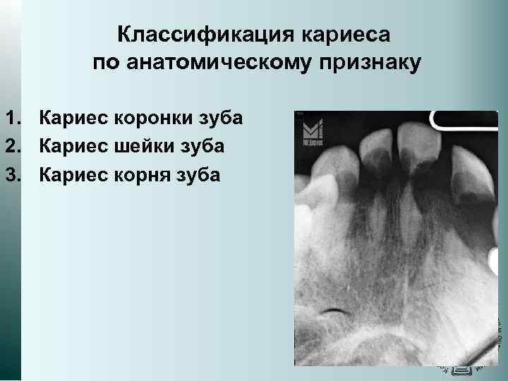 Классификация кариеса по анатомическому признаку 1. Кариес коронки зуба 2. Кариес шейки зуба 3.