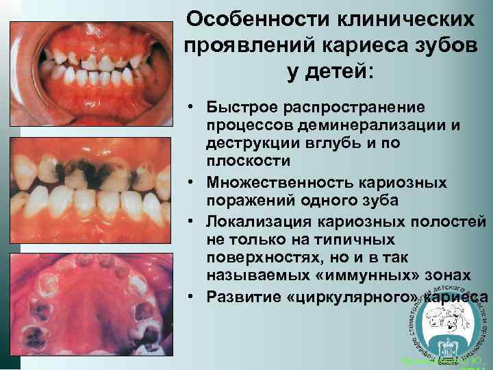 Особенности клинических проявлений кариеса зубов у детей: • Быстрое распространение процессов деминерализации и деструкции