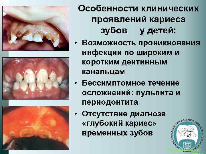 Особенности клинических проявлений кариеса зубов у детей: • Возможность проникновения инфекции по широким и