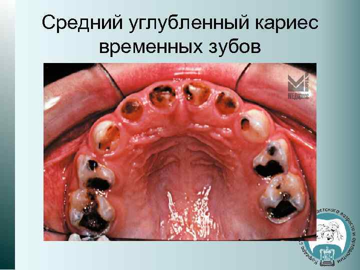 Кариес зубов картинки для детей дантистофф