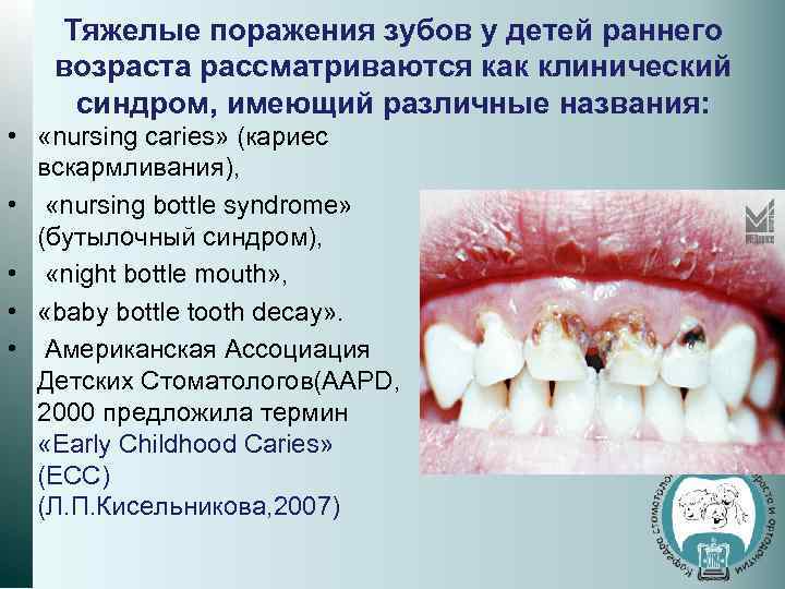 Тяжелые поражения зубов у детей раннего возраста рассматриваются как клинический синдром, имеющий различные названия: