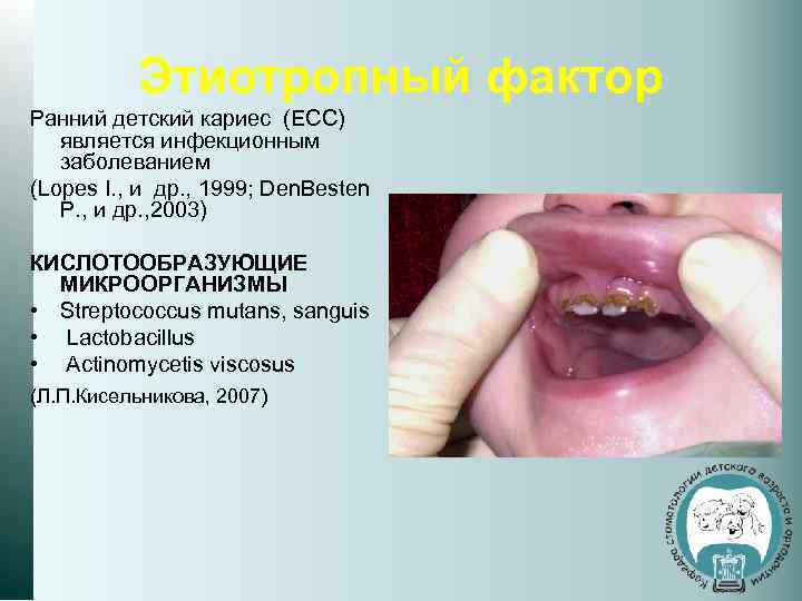 Этиотропный фактор Ранний детский кариес (ECC) является инфекционным заболеванием (Lopes I. , и др.