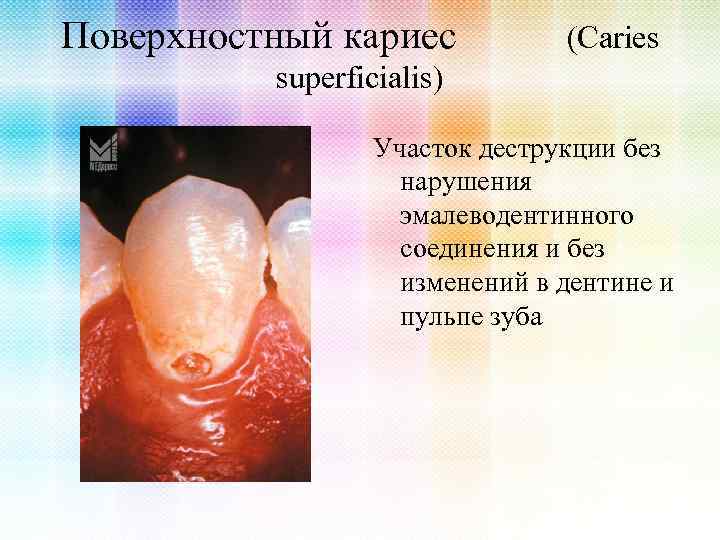 Поверхностный кариес (Caries superficialis) Участок деструкции без нарушения эмалеводентинного соединения и без изменений в