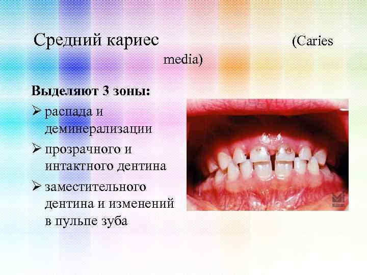 Средний кариес (Caries media) Выделяют 3 зоны: Ø распада и деминерализации Ø прозрачного и