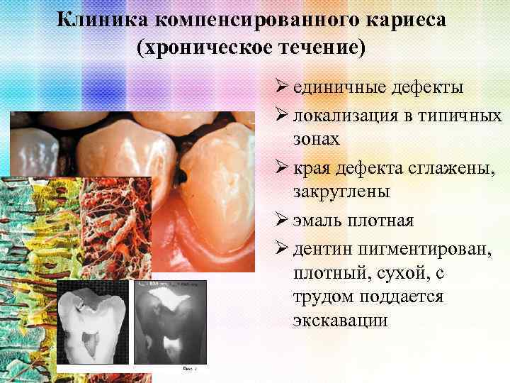 Клиника компенсированного кариеса (хроническое течение) Ø единичные дефекты Ø локализация в типичных зонах Ø