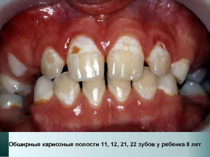 Обширные кариозные полости 11, 12, 21, 22 зубов у ребенка 8 лет 