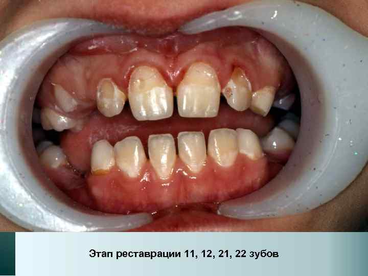 Этап реставрации 11, 12, 21, 22 зубов 