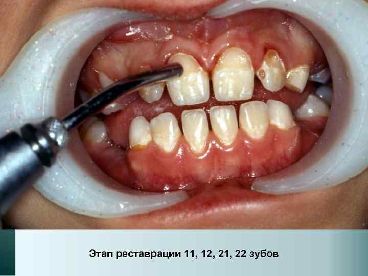 Этап реставрации 11, 12, 21, 22 зубов 