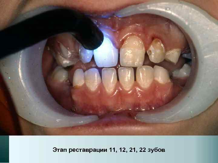 Этап реставрации 11, 12, 21, 22 зубов 