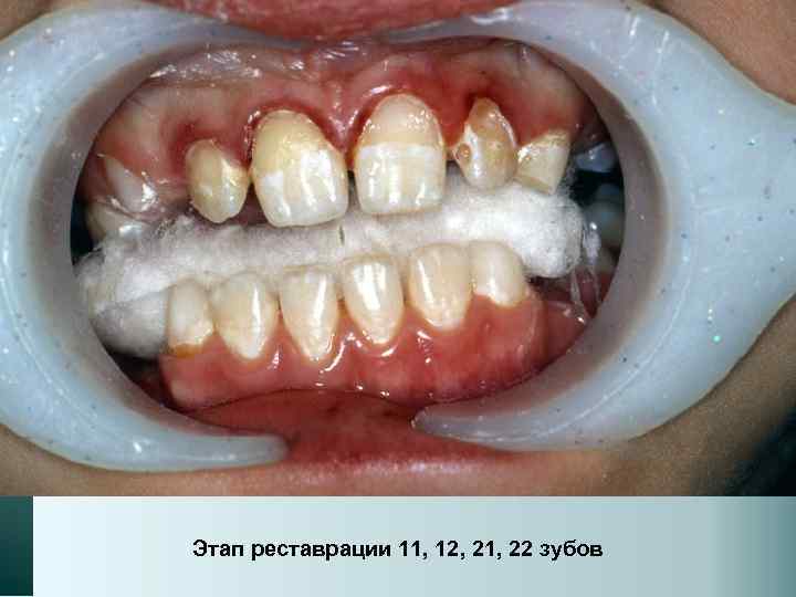 Этап реставрации 11, 12, 21, 22 зубов 