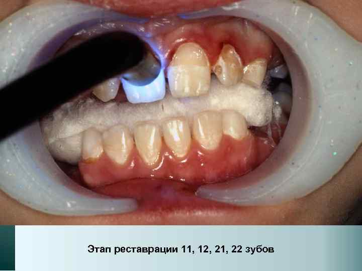 Этап реставрации 11, 12, 21, 22 зубов 