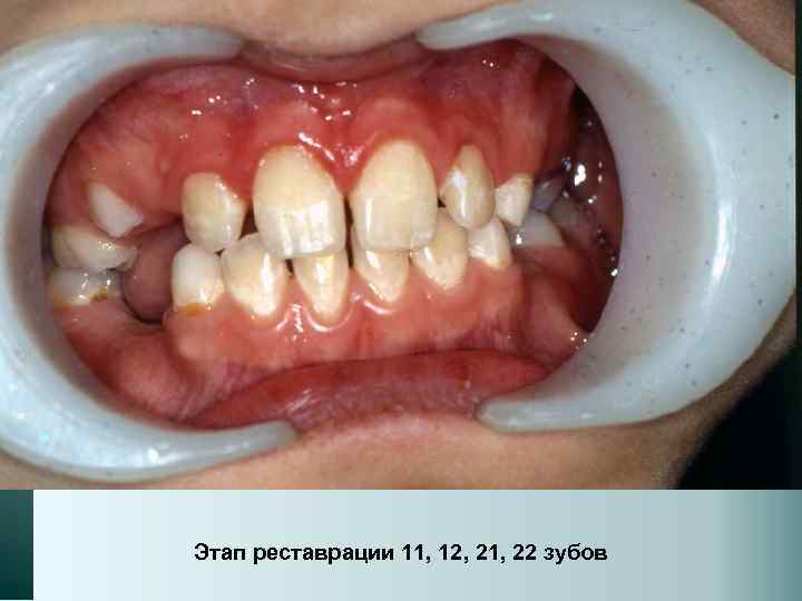 Этап реставрации 11, 12, 21, 22 зубов 