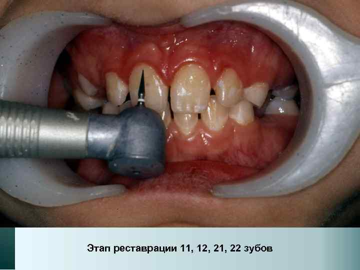 Этап реставрации 11, 12, 21, 22 зубов 