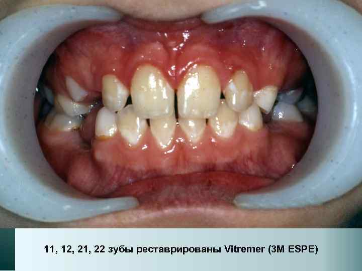 11, 12, 21, 22 зубы реставрированы Vitremer (3 M ESPE) 