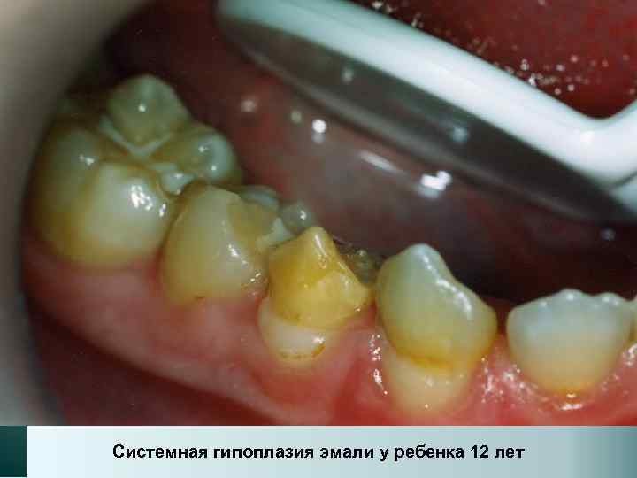 Системная гипоплазия эмали у ребенка 12 лет 