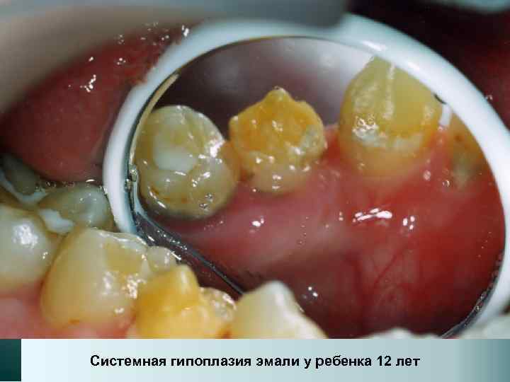 Системная гипоплазия эмали у ребенка 12 лет 