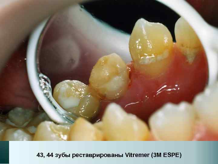 43, 44 зубы реставрированы Vitremer (3 M ESPE) 