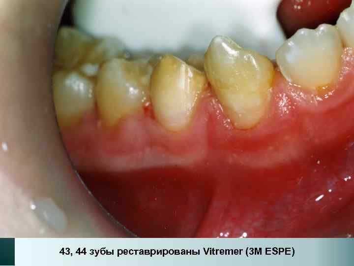 43, 44 зубы реставрированы Vitremer (3 M ESPE) 