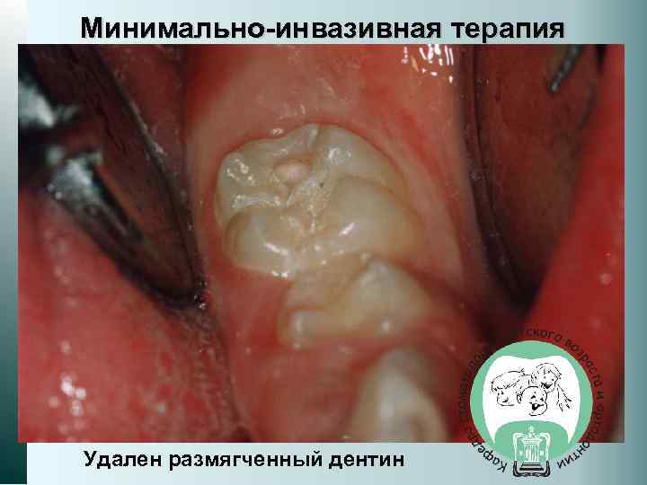 Минимально-инвазивная терапия Удален размягченный дентин 