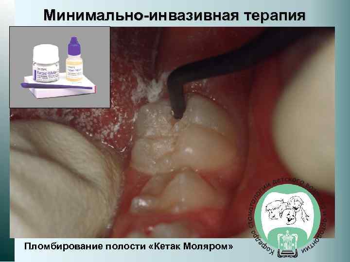 Минимально-инвазивная терапия Пломбирование полости «Кетак Моляром» 