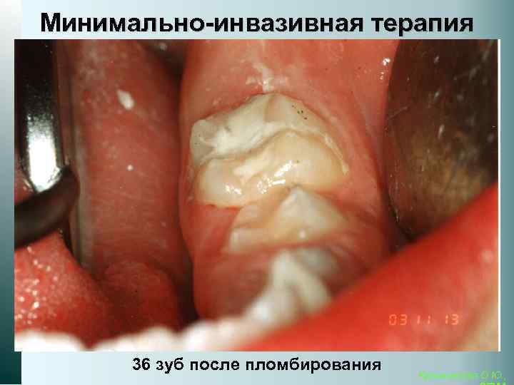 Минимально-инвазивная терапия 36 зуб после пломбирования Кузьминская О. Ю. , 