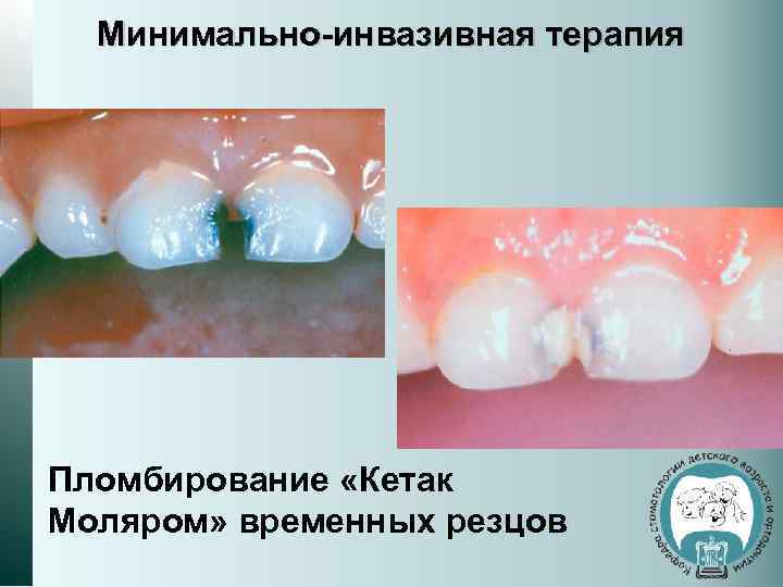 Минимально-инвазивная терапия Пломбирование «Кетак Моляром» временных резцов 