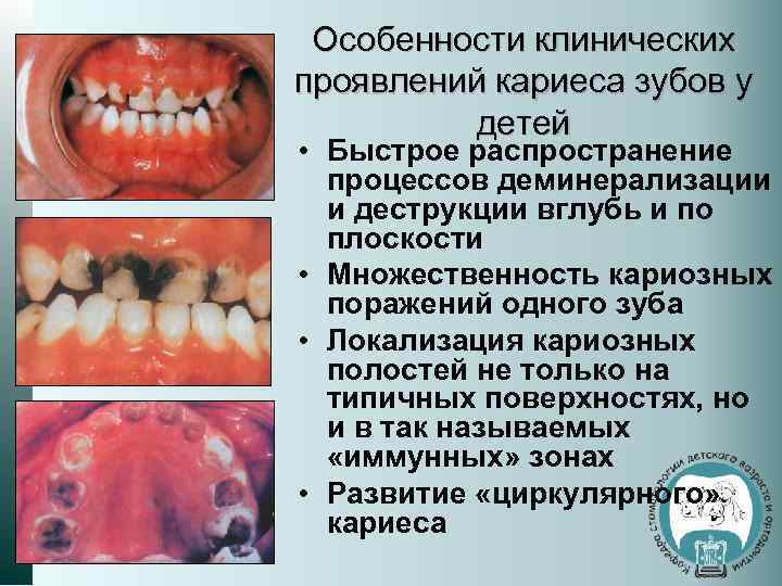 Особенности клинических проявлений кариеса зубов у детей • Быстрое распространение процессов деминерализации и деструкции