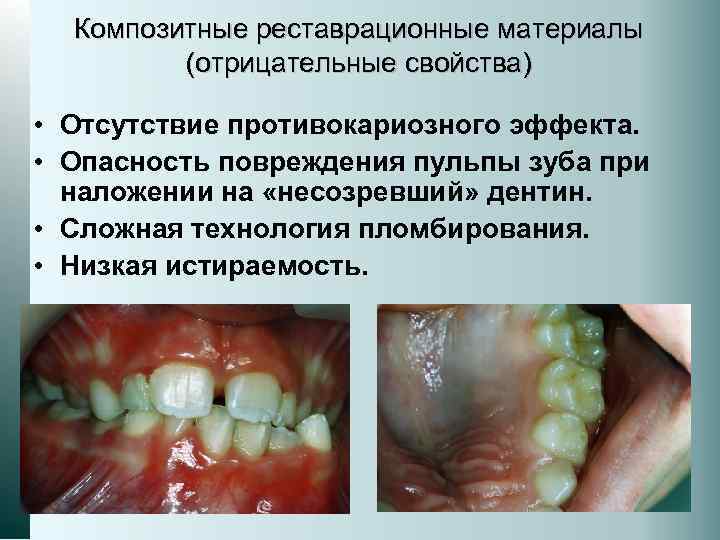 Композитные реставрационные материалы (отрицательные свойства) • Отсутствие противокариозного эффекта. • Опасность повреждения пульпы зуба