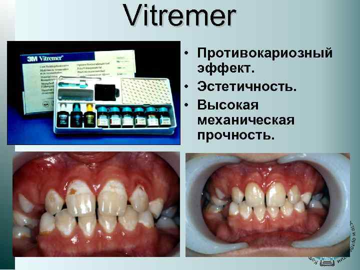 Vitremer • Противокариозный эффект. • Эстетичность. • Высокая механическая прочность. 