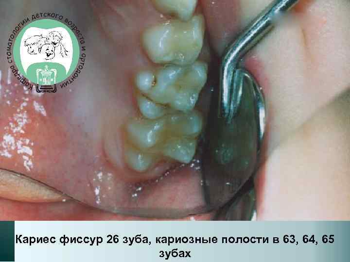 Кариес фиссур 26 зуба, кариозные полости в 63, 64, 65 зубах 