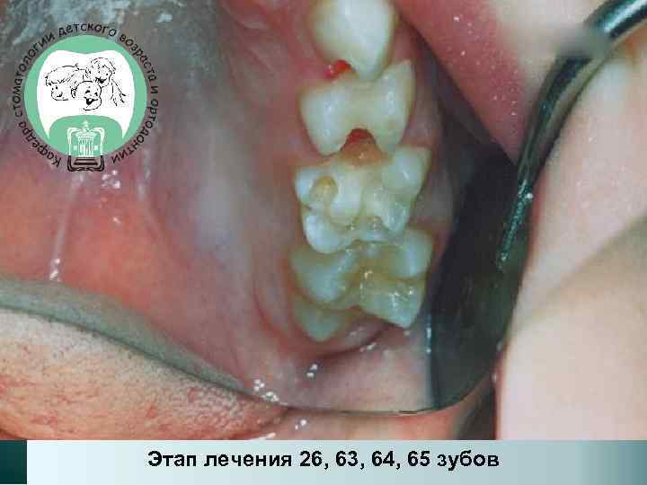 Этап лечения 26, 63, 64, 65 зубов 